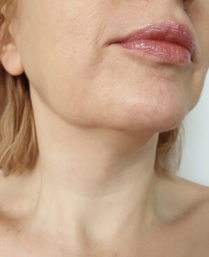 Condition FacialSagging FacialPalsy