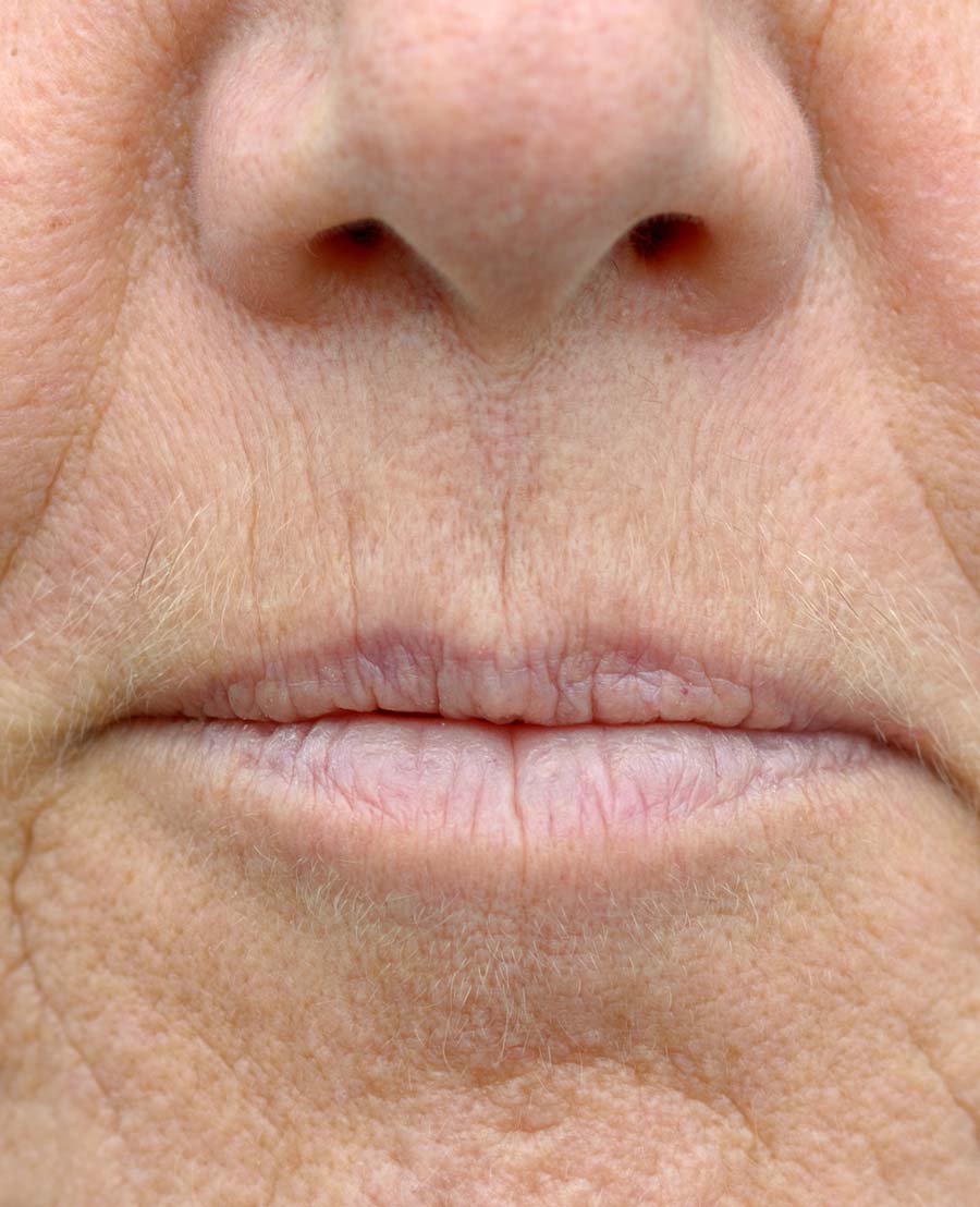 Smoker’s Lines And Nose to Mouth Lines Face Restoration