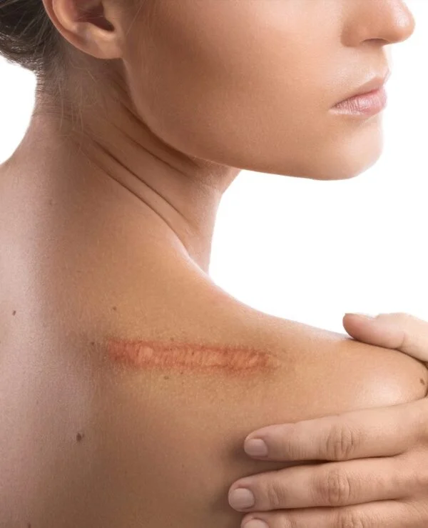 Scars, Keloid Scarring & Scar Management