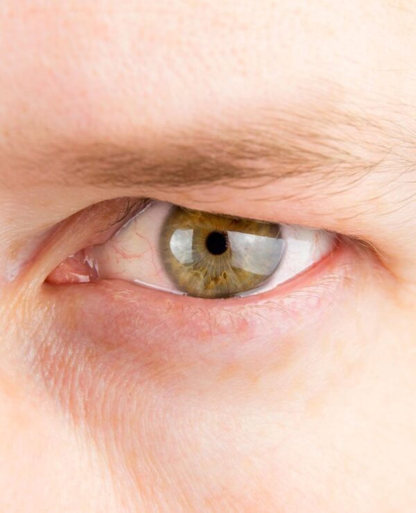 Dermatochalasis (Loose Skin) & Hooded Eyes