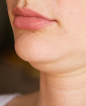 Condition DoubleChin