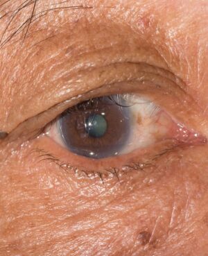 Condition Ectropion