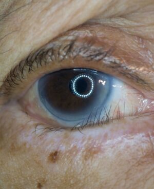 Condition Entropion