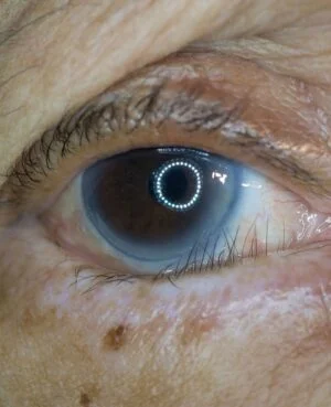 Condition Entropion