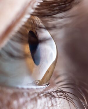 Condition EyelashLoss