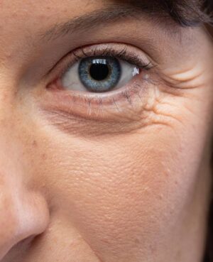 Condition Eyes CrowsFeet