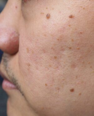 Condition Moles