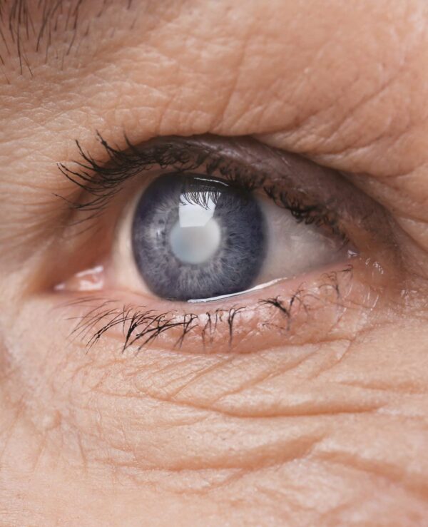 Prosthetic Eye, Artificial Eye & Blind Painful Eye
