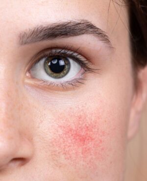Condition Rosacea