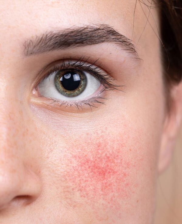Rosacea, Acne & Acne scars