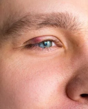 Condition Stye