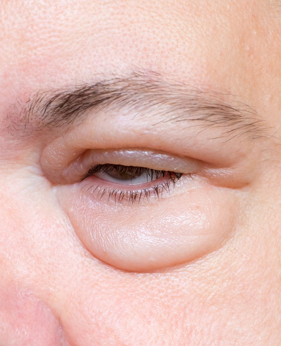 Swelling Around Eye & Orbital Swellings - Face Restoration Facial