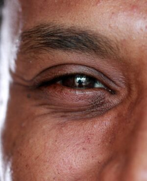 Face Restoration Punctoplasty Canaliculoplasty Stent Placement