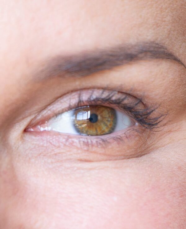 Revision lower eyelid blepharoplasty