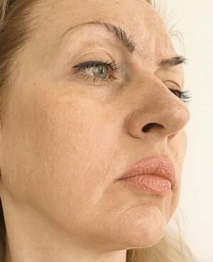 Sagging Skin & Signs of Ageing & Crepey skin