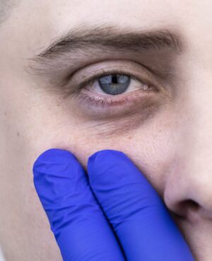 Face Restoration Same day diagnostic excision reconstruction