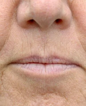 Face Restoration Smokers Lines Nose to Mouth Lines