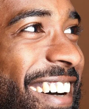 Face Restoration Surgical Revision