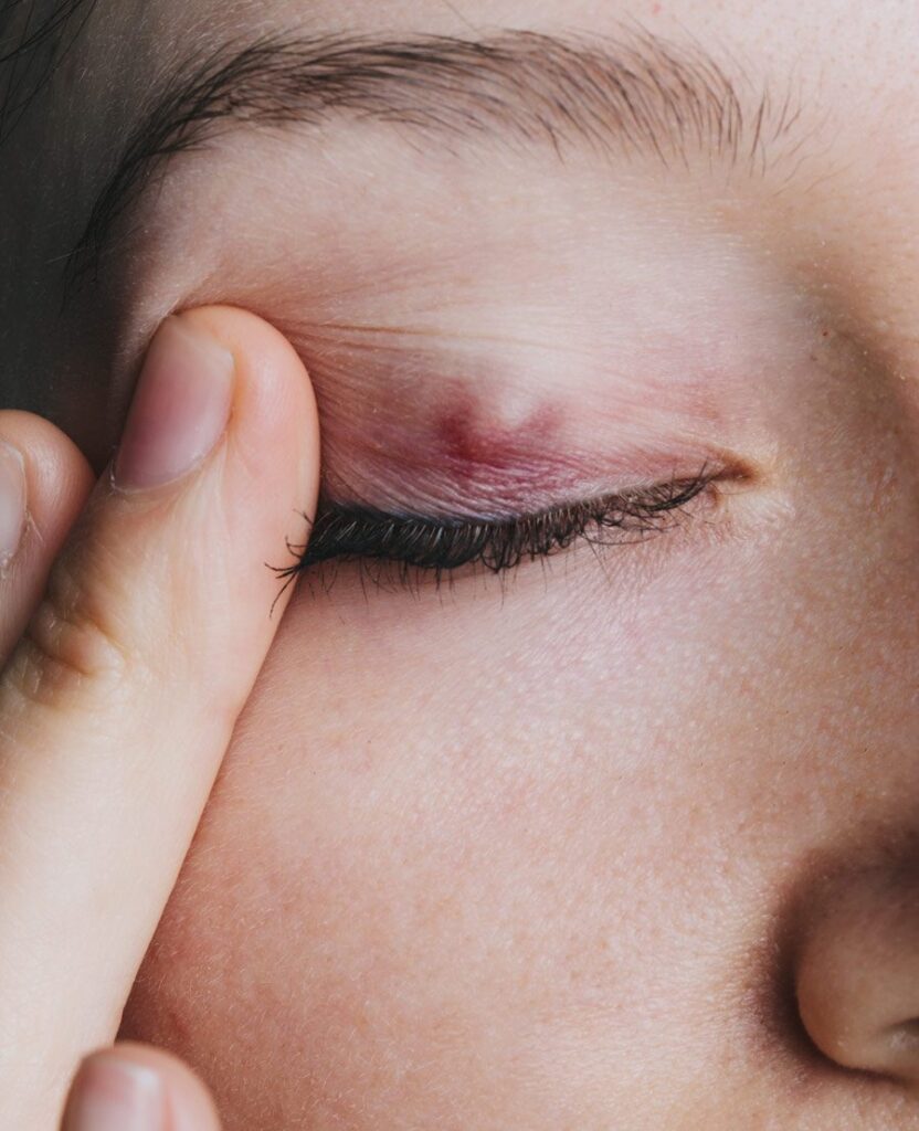 Get Rid of a Stye or Chalazion Incision & Curettage Treatments