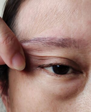 Treatment DoubleEyelid
