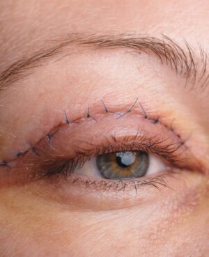 Treatment Upper eyelid blepharoplasty